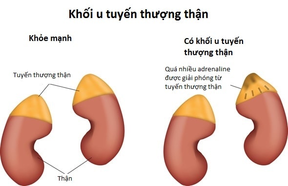 Tìm hiểu về u tuyến thượng thận: Khi nào cần mổ?